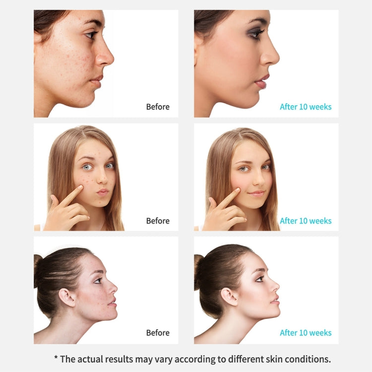 Xpreen Rechargeable Pore Cleanser Home Facial Beauty Device with LED Screen & 4 Probes - free shipping - PMC Jewellery - Order now!