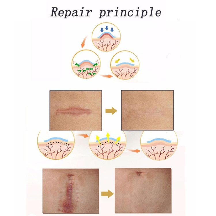 Organic silicone Gel Scar Therapy Patch be Washed and Reused - free shipping - PMC Jewellery - Order now!