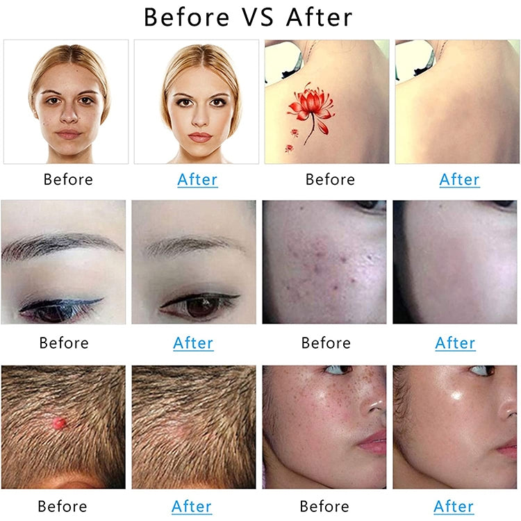 AA-A401 Small Freckle and Mole Removal Pen Tattoo and Eyebrow Removal Beauty Instrument, Color: Blu-ray Battery