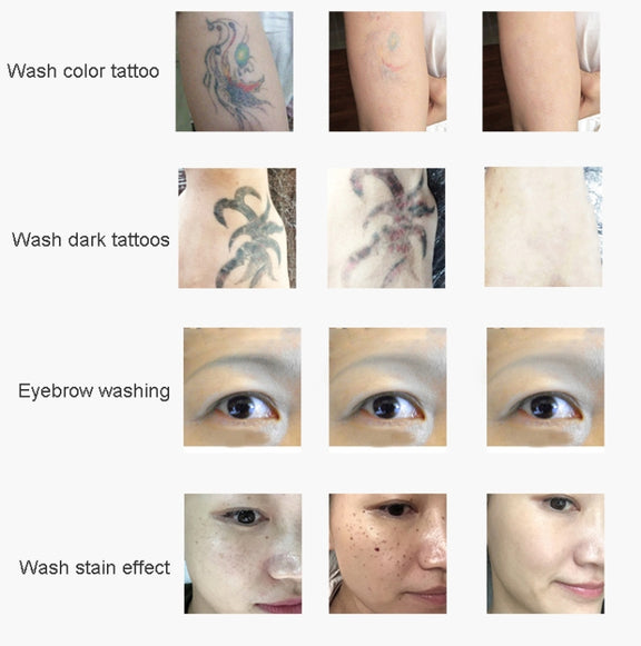 Laser Tattoo Removal Machine Non-invasive Eyebrow Washing Beauty Equipment(UK Plug)