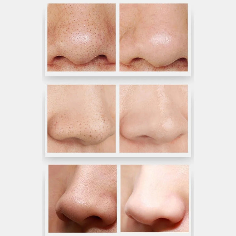 ZLY-018 Household Electric Blackhead Suction Device Pore Cleaning and Beauty Equipment(Standard) - free shipping - PMC TechLife - Order now!