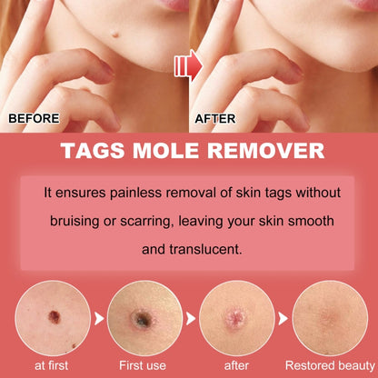 Ximonth 20ml/Bottle Anti Mole And Wart Liquid Dark Spot Tag Remover Skin Essence - free shipping - PMC Jewellery - Order now!