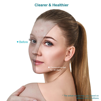 Xpreen  Blue & Red Light Therapy Acne Treatment Face Mask - free shipping - PMC Jewellery - Order now!
