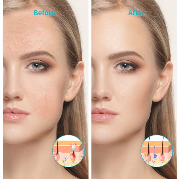 XPREEN XPRE052 Wireless Rechargeable Light Acne Treatment Device Home Acne Clearing Eraser with Blue Light and Red Light(White) - free shipping - PMC Jewellery - Order now!