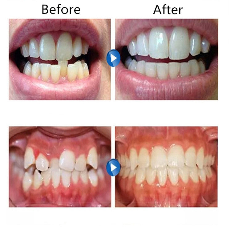 Orthodontic Appliance Silicone Simulation Braces Anti-molar Braces for Night(The first stage)