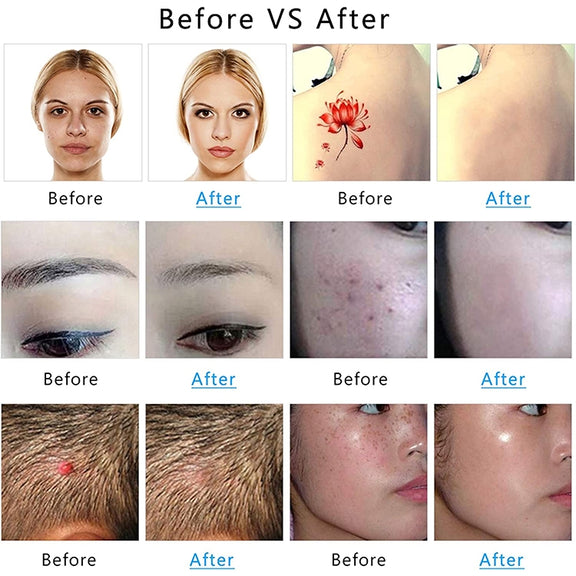 AA-A401 Small Freckle and Mole Removal Pen Tattoo and Eyebrow Removal Beauty Instrument, Color: Blu-ray Plug-in