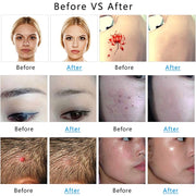 AA-A401 Small Freckle and Mole Removal Pen Tattoo and Eyebrow Removal Beauty Instrument, Color: Red Light Battery