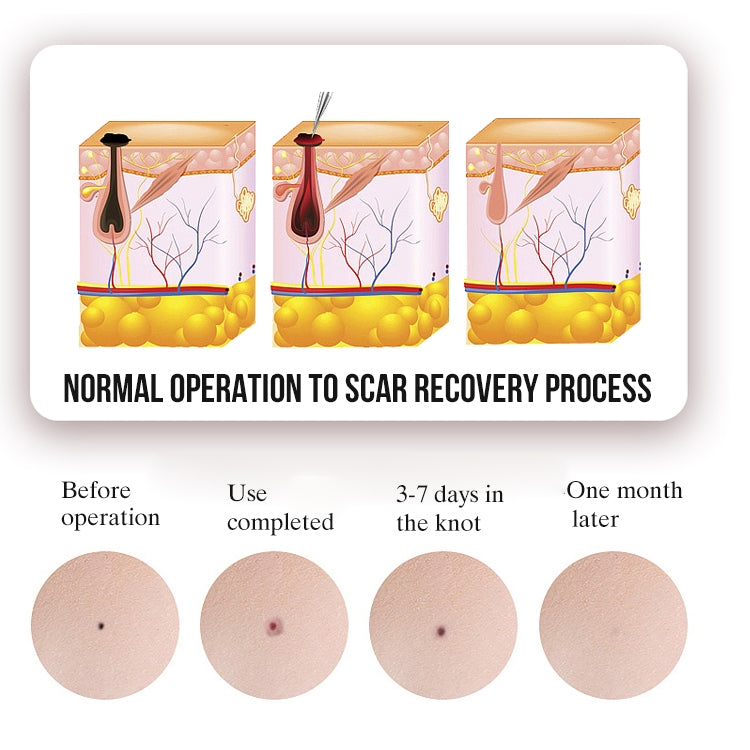 FY-106 Portable Mole and Freckle Removal Pen Household Laser Beauty Equipment(Blue) - Clothing & Beauty by PMC TechLife | Online Shopping South Africa | PMC TechLife