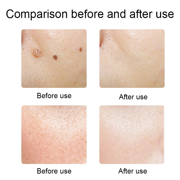 FY-106 Portable Mole and Freckle Removal Pen Household Laser Beauty Equipment(Blue) - Clothing & Beauty by PMC TechLife | Online Shopping South Africa | PMC TechLife