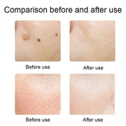 FY-106 Portable Mole and Freckle Removal Pen Household Laser Beauty Equipment(Blue)