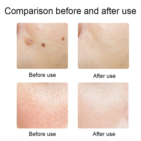 FY-106 Portable Mole and Freckle Removal Pen Household Laser Beauty Equipment(Blue)