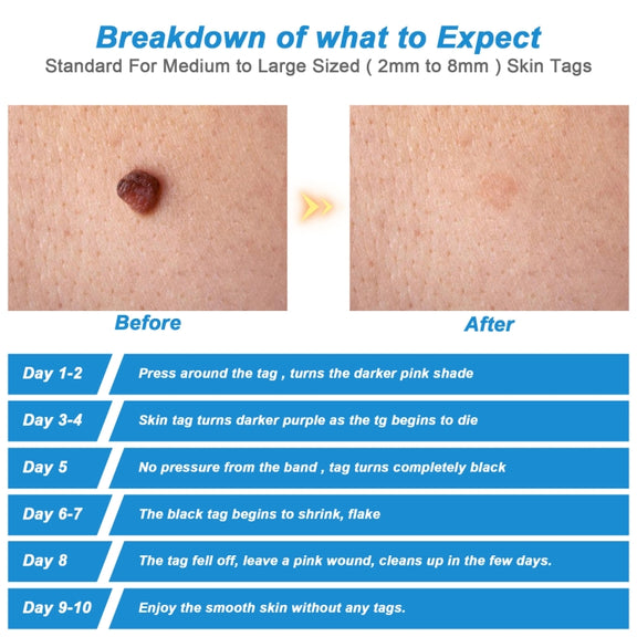 2 IN 1 Auto Skin Tag Remover Device Adult Mole Wart Remover Face Care Beauty Tools