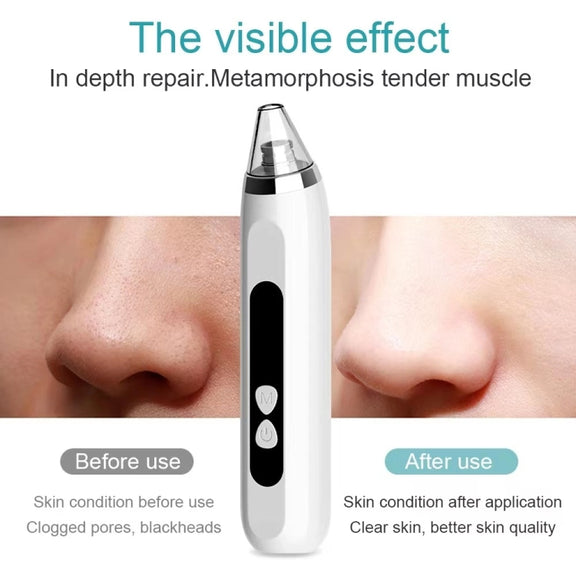 Blackhead Remover Vacuum Pore Cleaner Facial Deep Cleaning Beauty Tools(White)